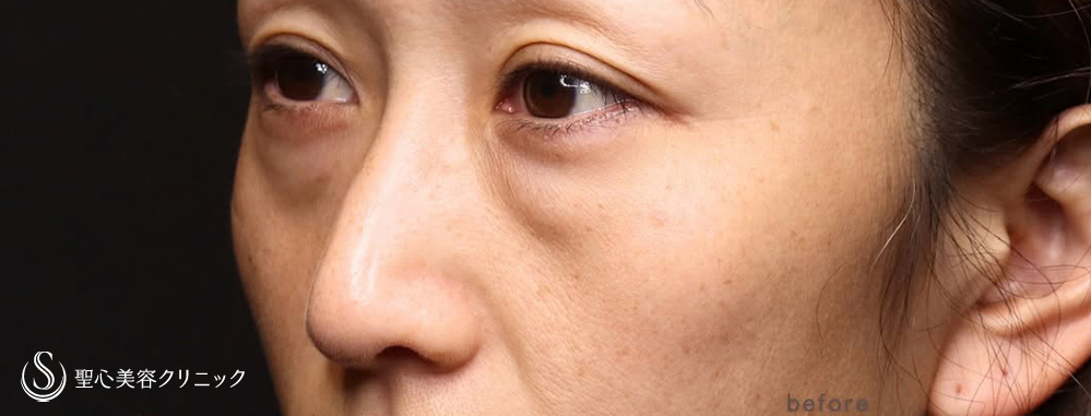 【40代女性・目の下のたるみ】下眼瞼切開術/下眼瞼除皺術/脂肪除去（3ヶ月後） Before 