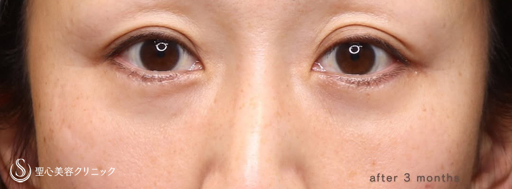【40代女性・目の下のたるみ】下眼瞼切開術/下眼瞼除皺術/脂肪除去（3ヶ月後） After 