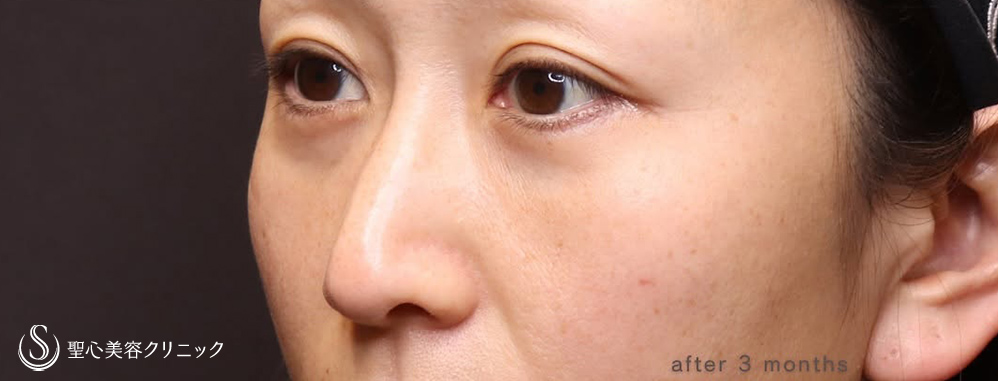 【40代女性・目の下のたるみ】下眼瞼切開術/下眼瞼除皺術/脂肪除去（3ヶ月後） After 