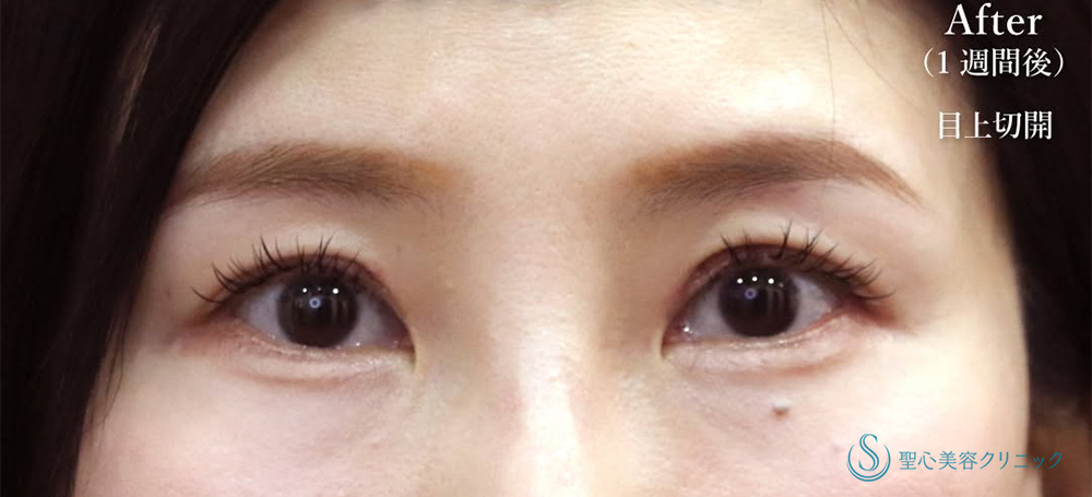 【30代女性・パッと明るい目元に】目上切開（1週間後） After 