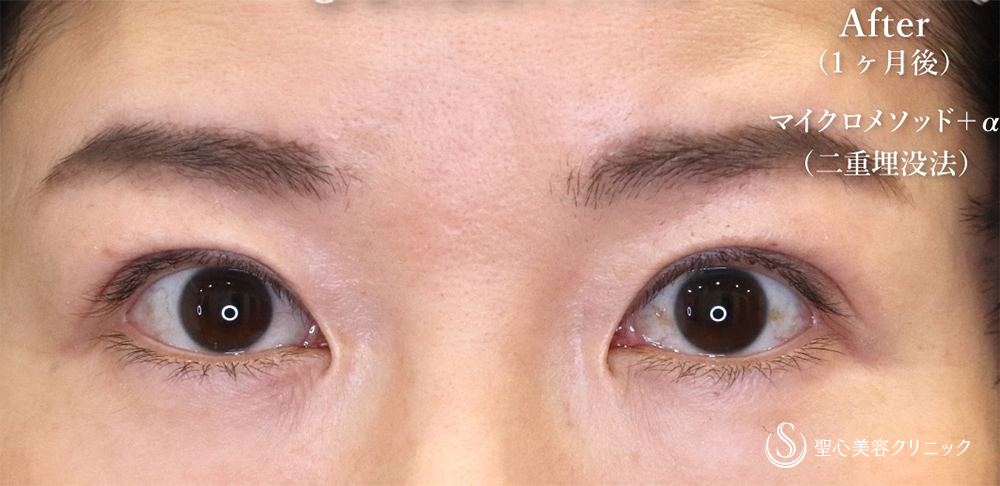 【40代女性・緩んできた埋没法をもう一度】マイクロメソッド＋α（二重埋没法）（1ヶ月後） After 
