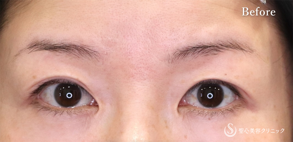 【40代女性・緩んできた埋没法をもう一度】マイクロメソッド＋α（二重埋没法）（1ヶ月後） Before 