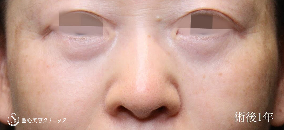 【50代女性・ミッドチークリフトで理想的なカーブに】下眼瞼切開術／下眼瞼除皺術／ハムラ法（1ヶ月後） After 