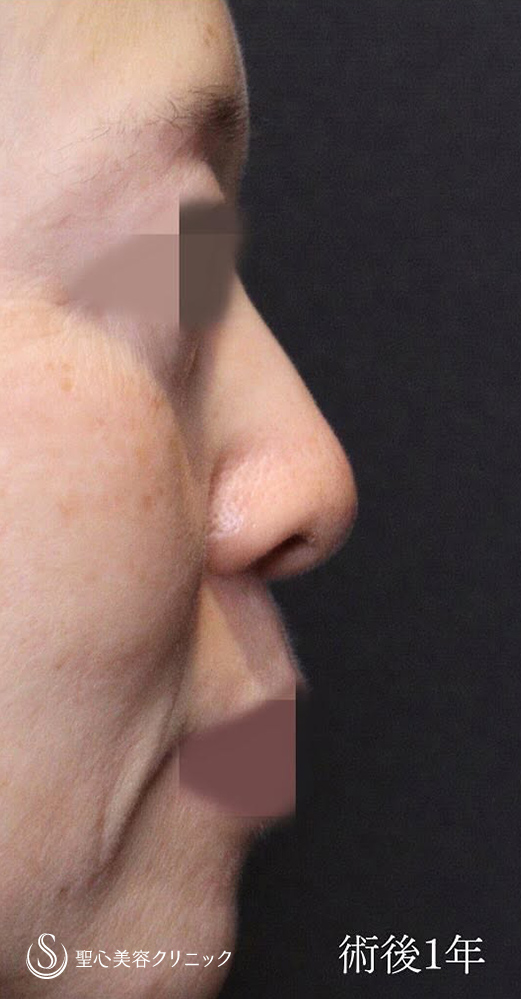【50代女性・ミッドチークリフトで理想的なカーブに】下眼瞼切開術／下眼瞼除皺術／ハムラ法（1ヶ月後） After 
