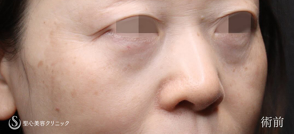 【50代女性・ミッドチークリフトで理想的なカーブに】下眼瞼切開術／下眼瞼除皺術／ハムラ法（1ヶ月後） Before 