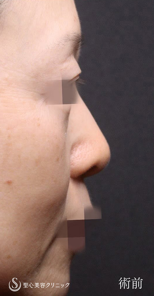 【50代女性・ミッドチークリフトで理想的なカーブに】下眼瞼切開術／下眼瞼除皺術／ハムラ法（1ヶ月後） Before 