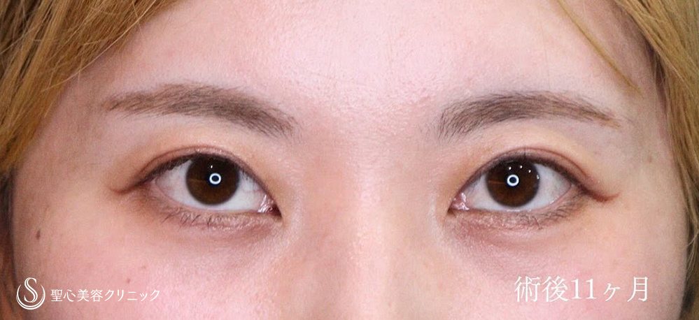 【30代女性・二重切開でスッキリとしたお目元に】二重術（切開法）（1ヶ月後） After 