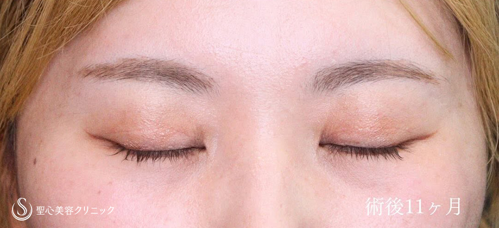 【30代女性・二重切開でスッキリとしたお目元に】二重術（切開法）（1ヶ月後） After 