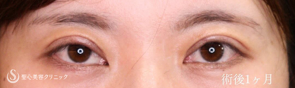 【30代女性・二重切開でスッキリとしたお目元に】二重術（切開法）（1ヶ月後） After 