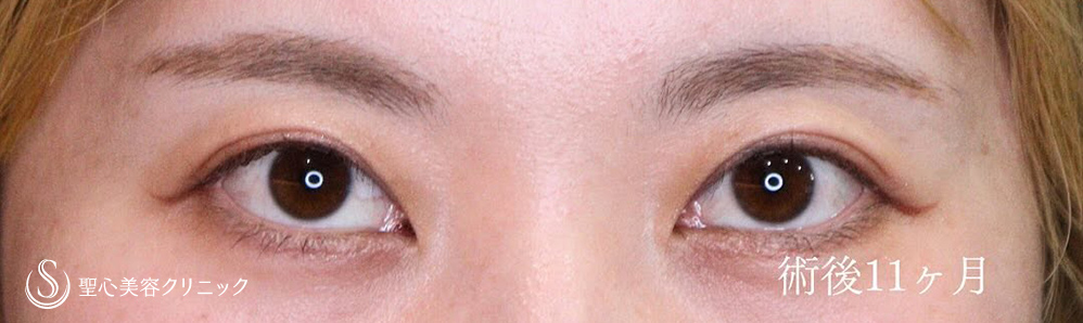 【30代女性・二重切開でスッキリとしたお目元に】二重術（切開法）（1ヶ月後） After 