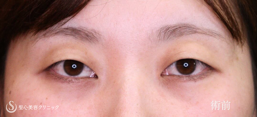 【30代女性・二重切開でスッキリとしたお目元に】二重術（切開法）（1ヶ月後） Before 