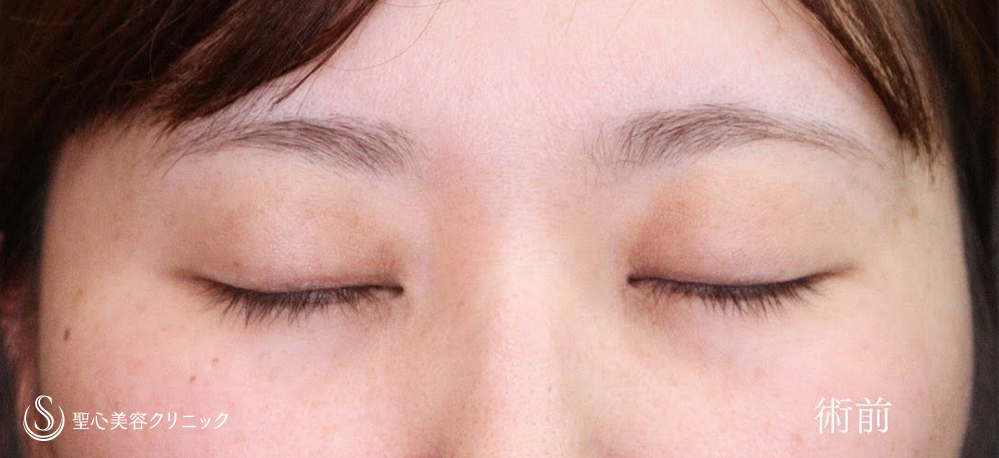 【30代女性・二重切開でスッキリとしたお目元に】二重術（切開法）（1ヶ月後） Before 