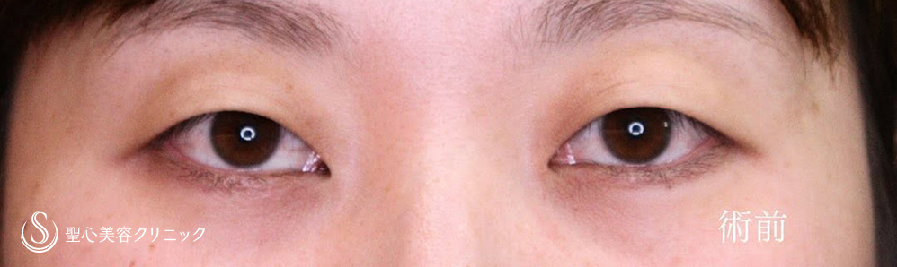 【30代女性・二重切開でスッキリとしたお目元に】二重術（切開法）（1ヶ月後） Before 