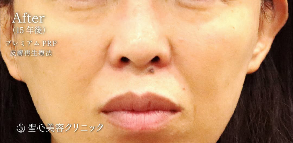 【50代女性・目の下の長期的な若返り】プレミアムPRP皮膚再生療法（15年経過後） After 