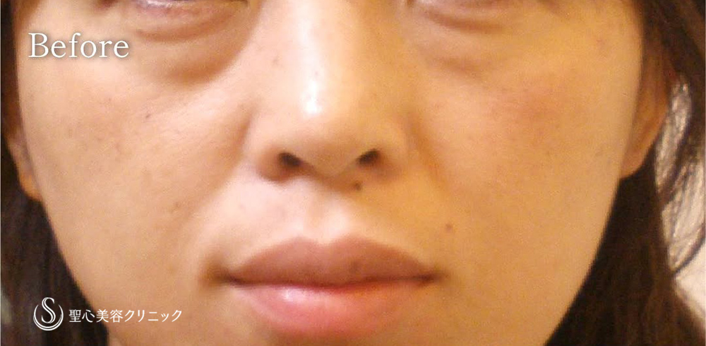 【50代女性・目の下の長期的な若返り】プレミアムPRP皮膚再生療法（15年経過後） Before 