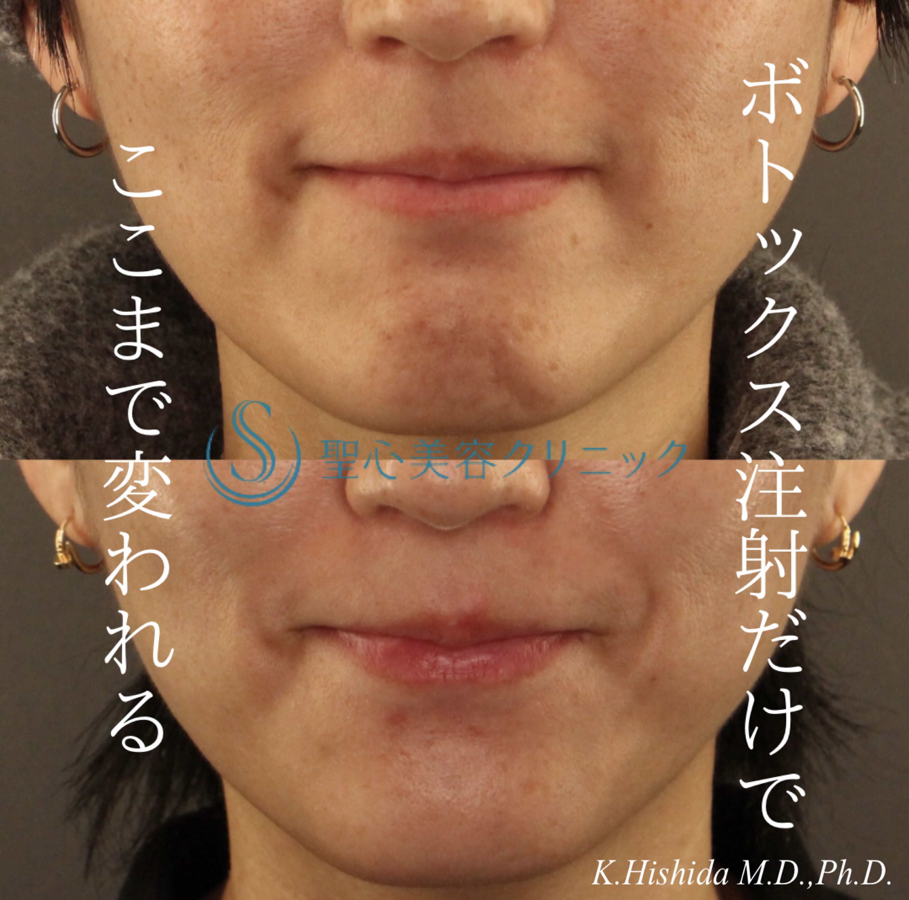 【30代女性・注射1回でここまで輪郭がキレイに】ボトックス注入（あご）（2ヶ月後） After 