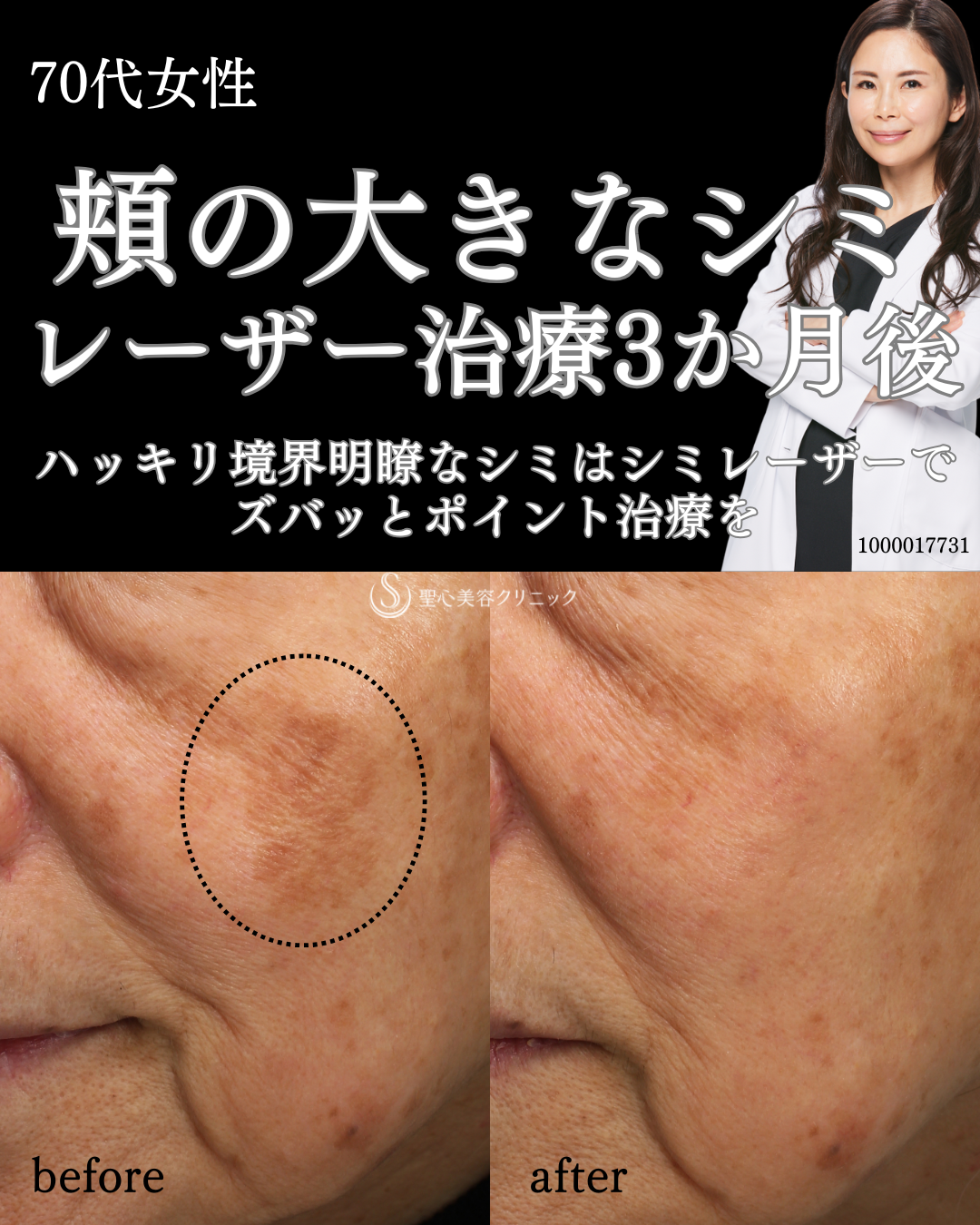 【70代女性・頬のシミ】QスイッチYAGレーザー（3ヶ月後） After 