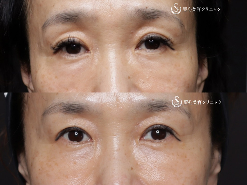 【50代女性・目の下の自然な若返り】プレミアムPRP皮膚再生療法（6ヶ月後） After 