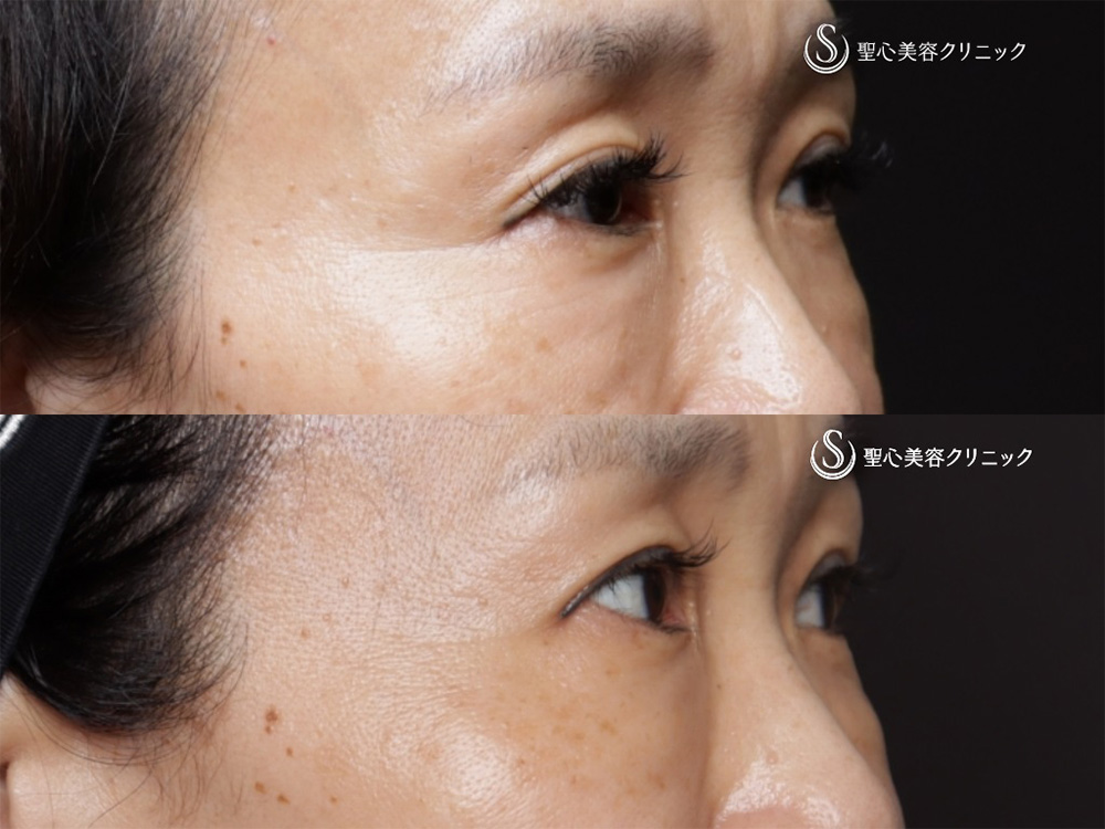 【50代女性・目の下の自然な若返り】プレミアムPRP皮膚再生療法（6ヶ月後） After 
