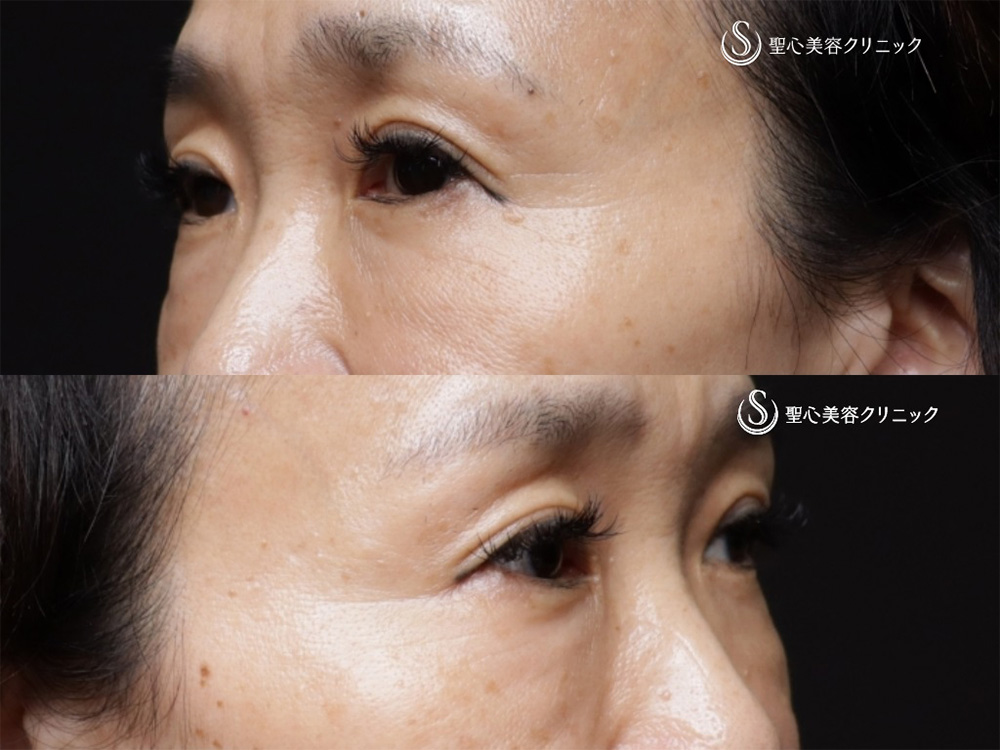 【50代女性・目の下の自然な若返り】プレミアムPRP皮膚再生療法（6ヶ月後） Before 