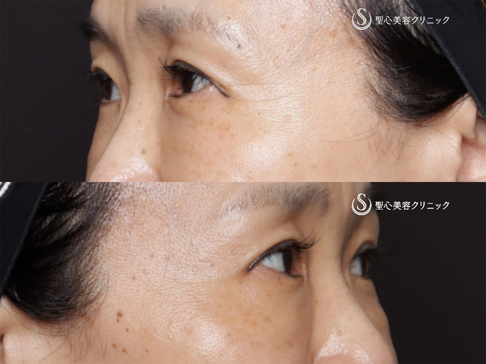 【50代女性・目の下の自然な若返り】プレミアムPRP皮膚再生療法（6ヶ月後） After 