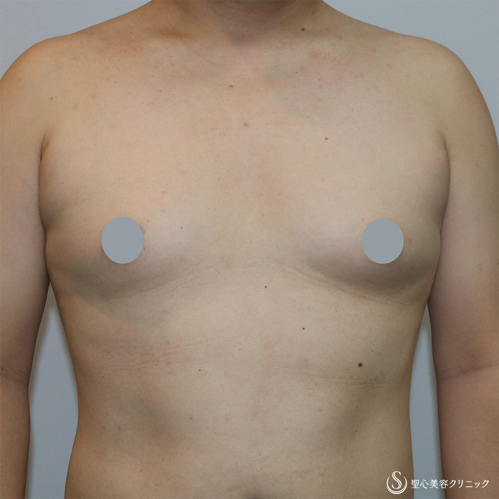 【40代男性・偽性女性化乳房】 女性化乳房修正術（男性対象）（1ヶ月後） Before 