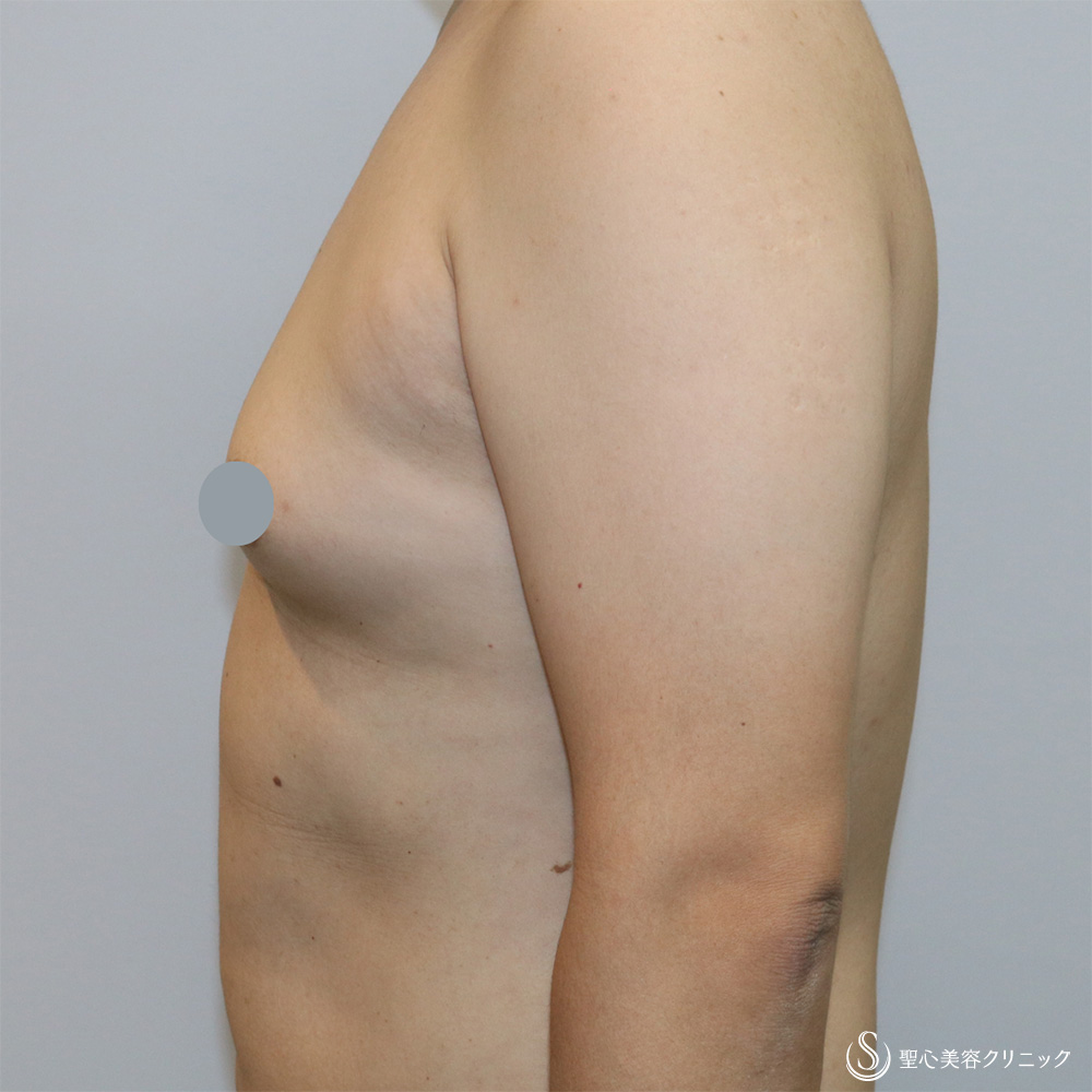 【40代男性・偽性女性化乳房】 女性化乳房修正術（男性対象）（1ヶ月後） Before 