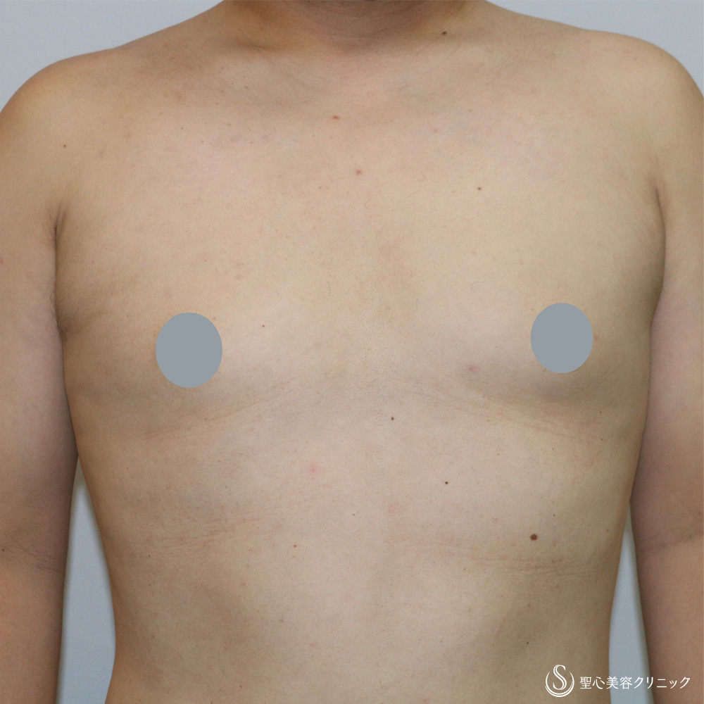 【40代男性・偽性女性化乳房】 女性化乳房修正術（男性対象）（1ヶ月後） After 