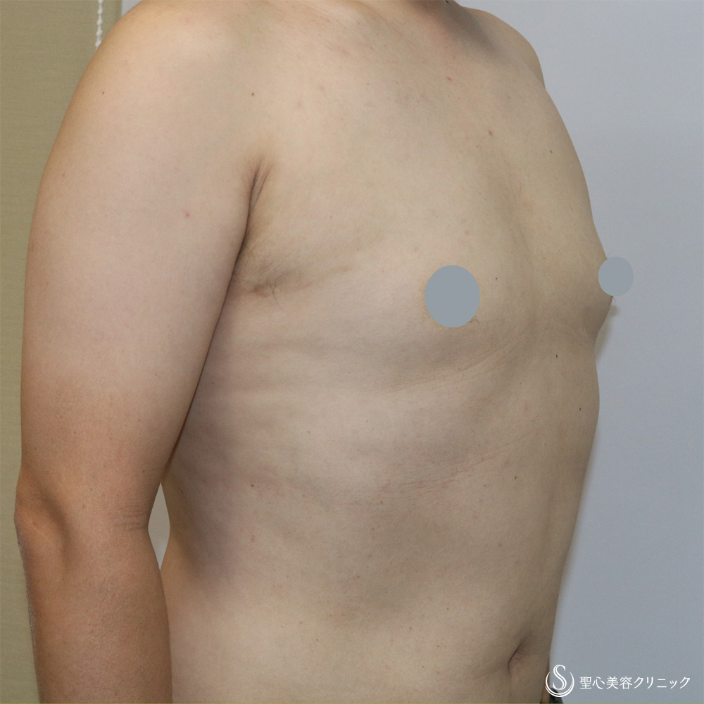 【40代男性・偽性女性化乳房】 女性化乳房修正術（男性対象）（1ヶ月後） After 