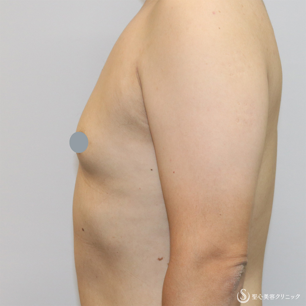 【40代男性・偽性女性化乳房】 女性化乳房修正術（男性対象）（1ヶ月後） After 