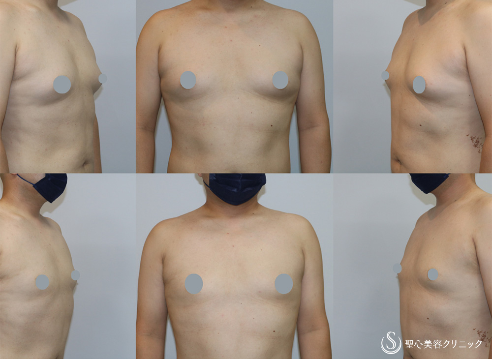 【40代男性・偽性女性化乳房】 女性化乳房修正術（男性対象）（1ヶ月後） After 