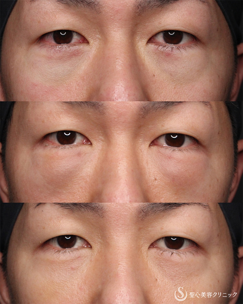 【40代男性・疲れた印象を改善】経結膜下脱脂法（5日後） After 