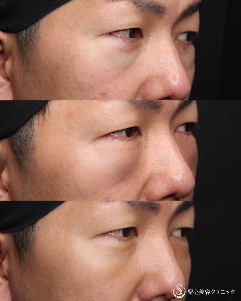 【40代男性・疲れた印象を改善】経結膜下脱脂法（5日後） After 