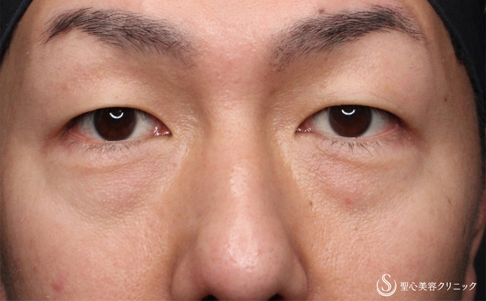 【40代男性・疲れた印象を改善】経結膜下脱脂法（5日後） Before 