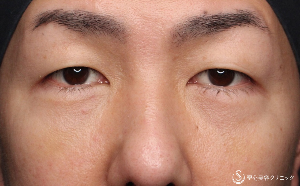 【40代男性・疲れた印象を改善】経結膜下脱脂法（5日後） After 