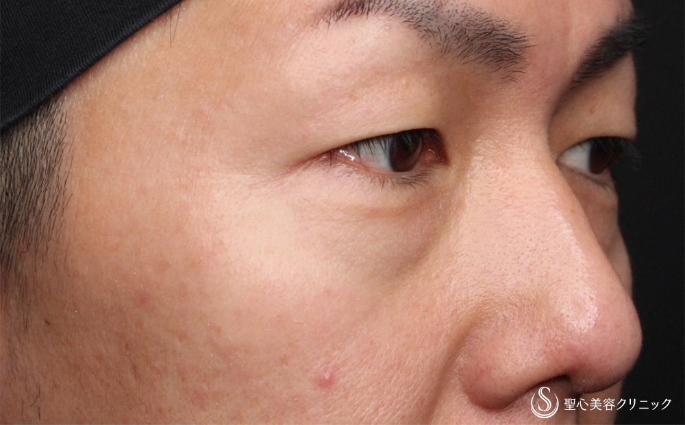 【40代男性・疲れた印象を改善】経結膜下脱脂法（5日後） Before 