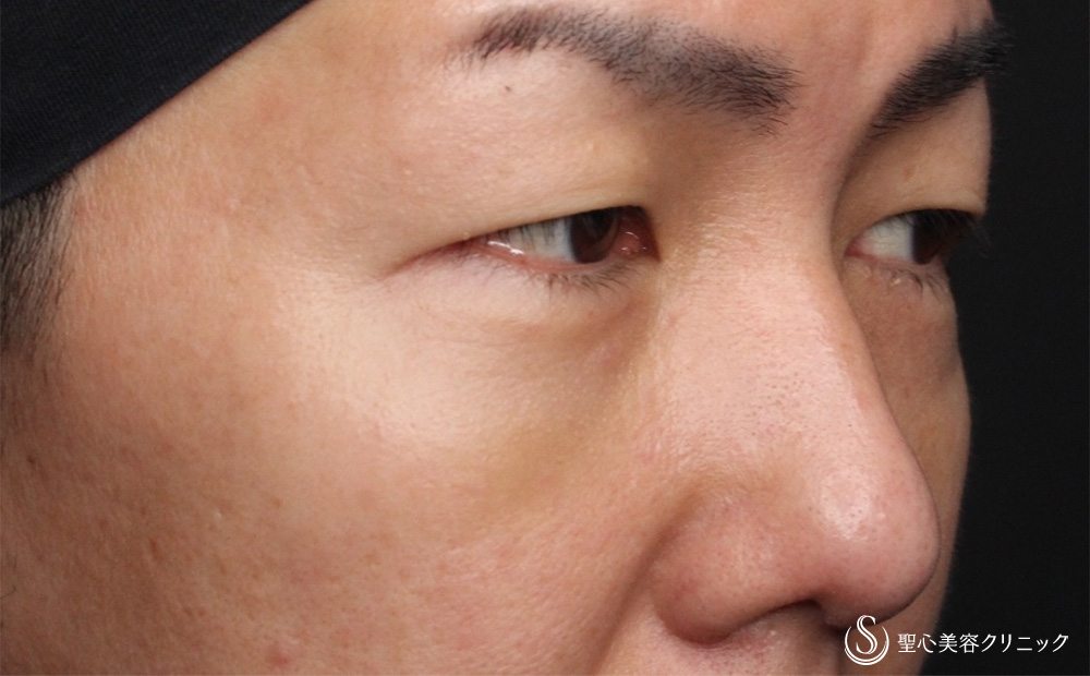 【40代男性・疲れた印象を改善】経結膜下脱脂法（5日後） After 