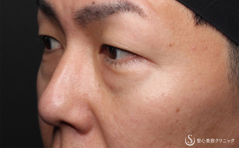 【40代男性・疲れた印象を改善】経結膜下脱脂法（5日後） Before 