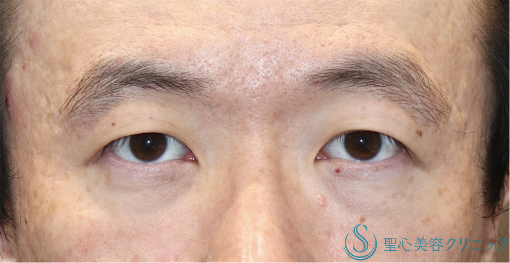 【30代男性・まぶたスッキリ】眉下リフト（1年後） Before 