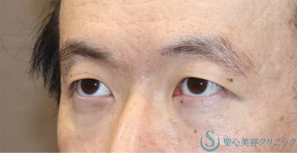 【30代男性・まぶたスッキリ】眉下リフト（1年後） Before 