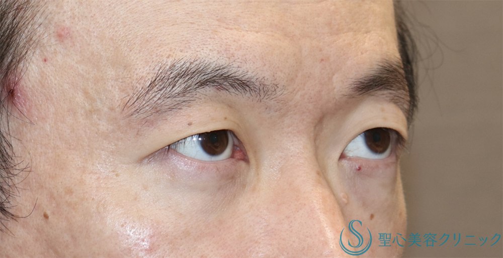 【30代男性・まぶたスッキリ】眉下リフト（1年後） Before 