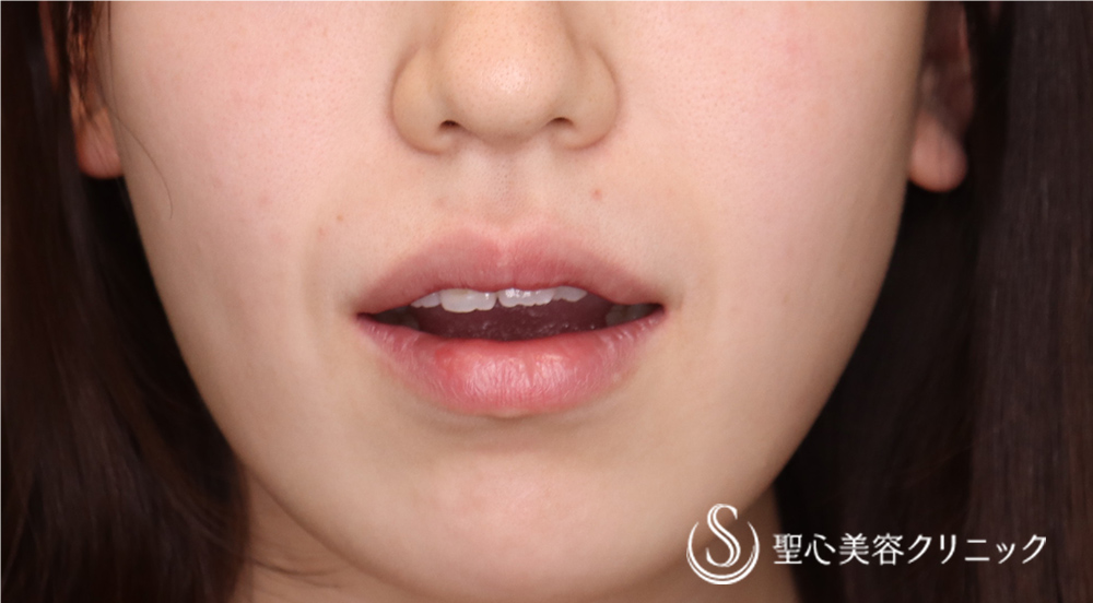 【20代女性・より可愛らしい口元にしたい！！】プレミアム口角挙上術（術後9日）（抜糸時） Before 