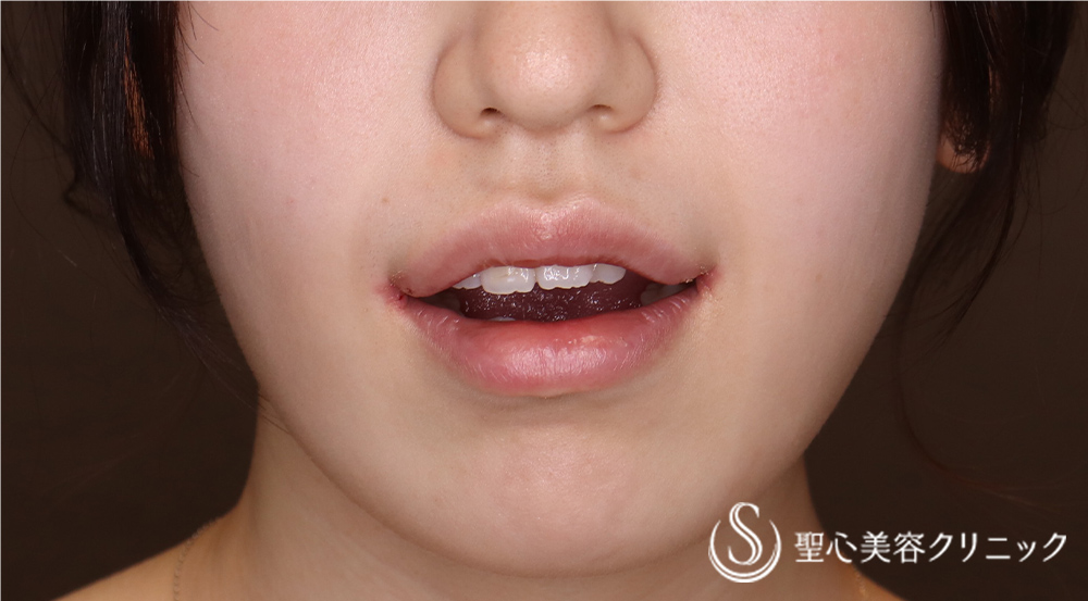 【20代女性・より可愛らしい口元にしたい！！】プレミアム口角挙上術（術後9日）（抜糸時） After 