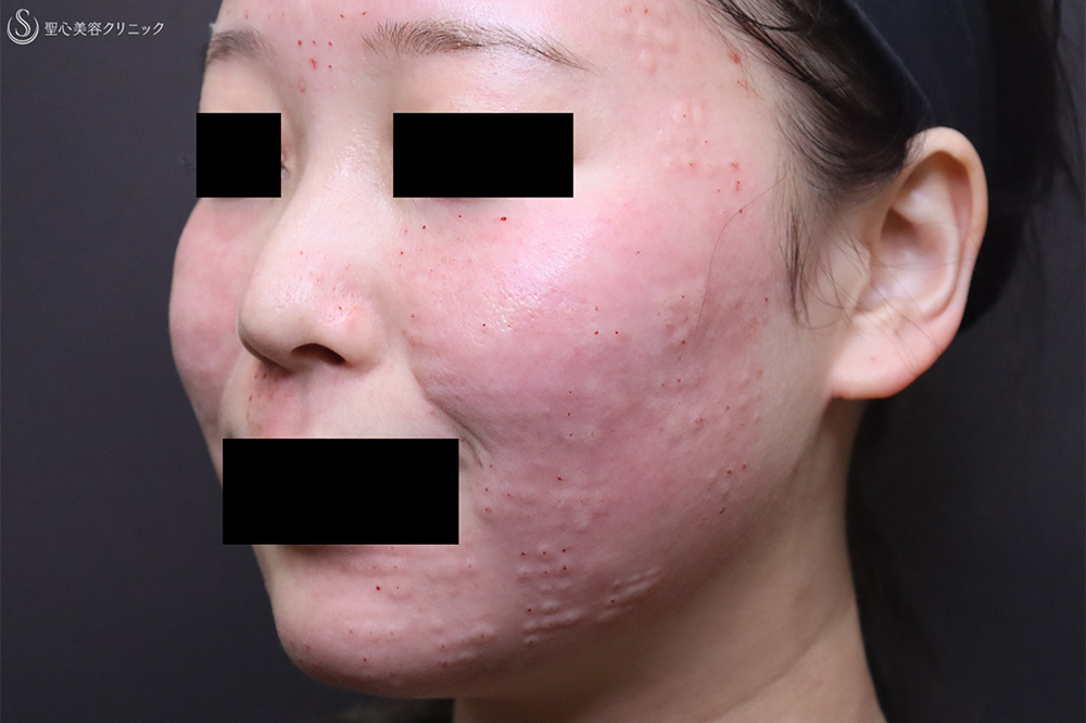 【20代女性・ハリツヤだけでなく赤みも改善】プルリアルデンシファイ（1週間後） After 