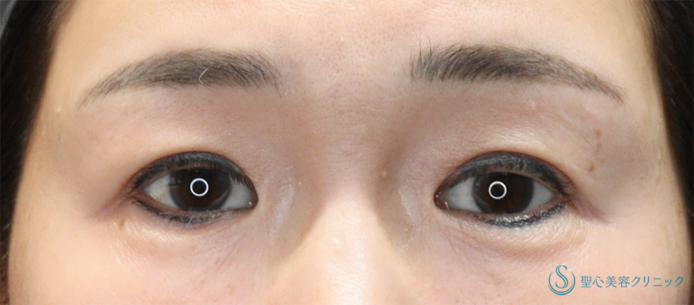 【50代女性・上瞼（まぶた）のたるみの改善、目の形の左右差を整える】眉下切開＋目頭切開＋目上切開（4ヶ月後） Before 