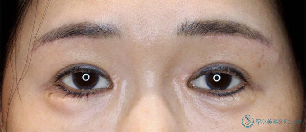 【50代女性・上瞼（まぶた）のたるみの改善、目の形の左右差を整える】眉下切開＋目頭切開＋目上切開（4ヶ月後） - 症例写真 - 美容整形、美容 ...