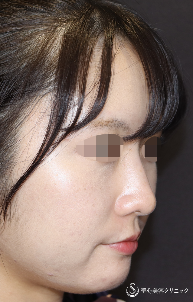 【20代女性・鼻先をスッキリ】ヒアルロン酸注入（鼻）（直後） After 