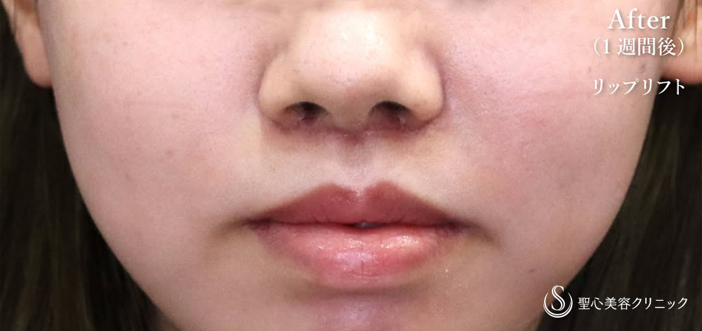 【20代女性・赤い唇輪郭をしっかり引き上げ】プレミアムリップリフト（1週間後） After 