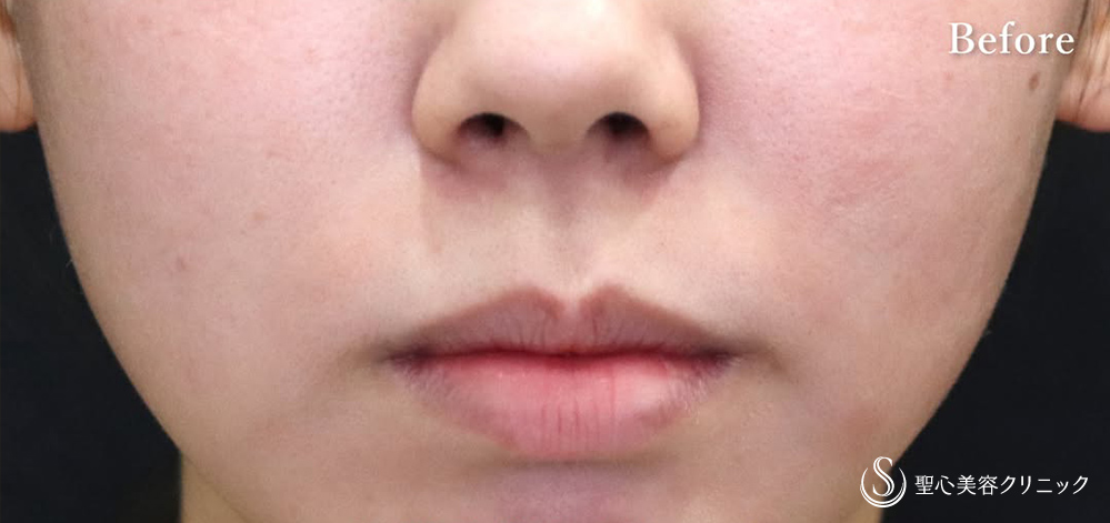 【20代女性・赤い唇輪郭をしっかり引き上げ】プレミアムリップリフト（1週間後） Before 