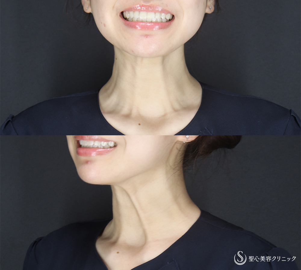 【20代女性・ボトックスリフトですっきりしたフェイスライン＆お顔のリフトアップ】ボトックスリフト（14日後） After 